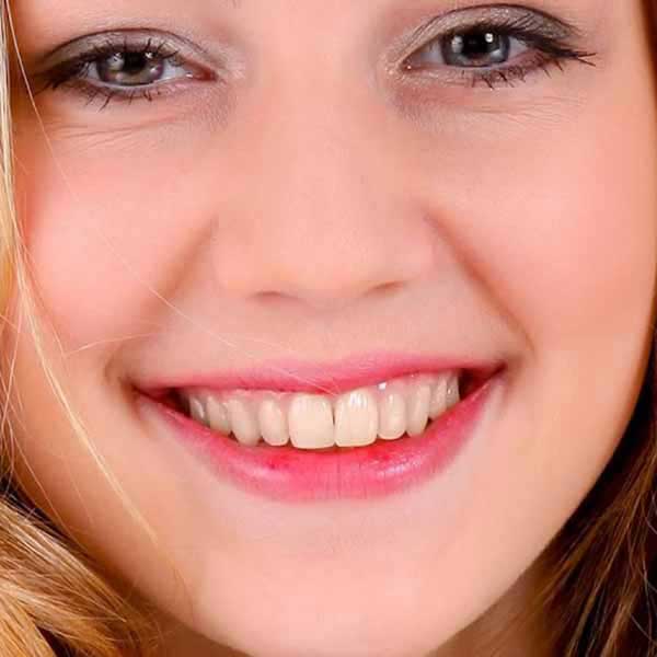 Pasa Dental'de tedavi öncesi ve sonrası karşılaştırması - Çürük dişler ve sağlıklı restorasyon